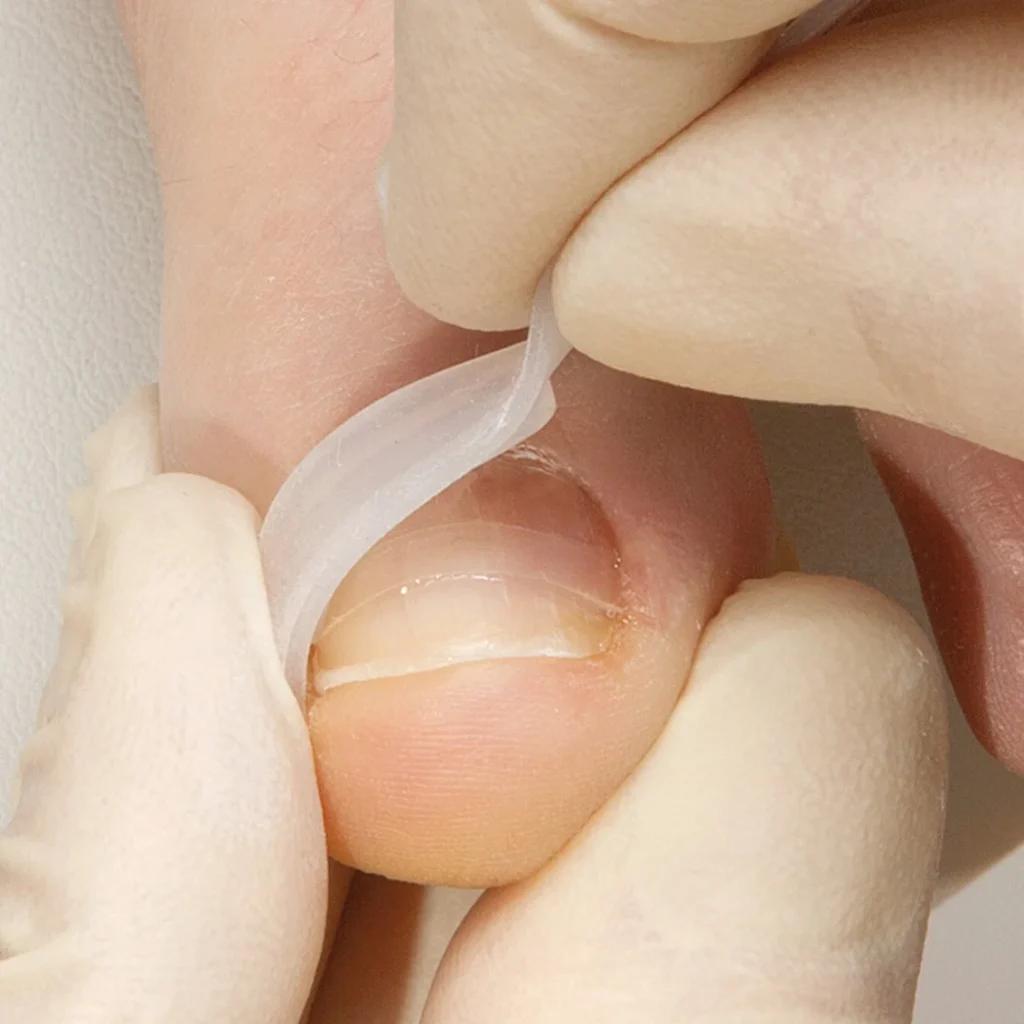 PODOLOGA - APPLICAZIONE BS SPANGE